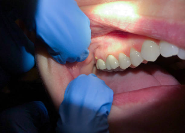 Best Emergency Dental Care for Broken or Chipped Teeth in Oral City, FL